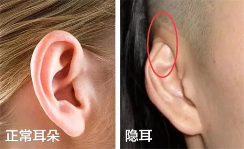 隐耳是什么？
