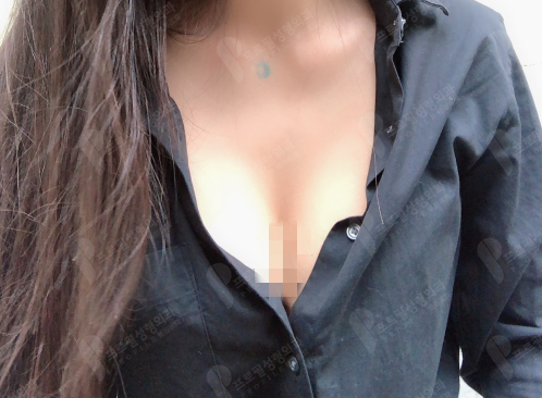 韩国普罗菲耳隆胸真人实例