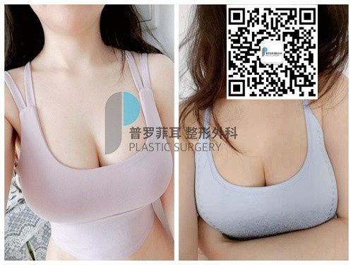 做曼托隆胸需要多少钱？