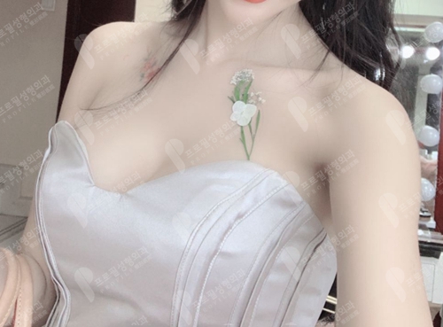 假体隆胸两胸间距太宽是基础不好还做坏了？